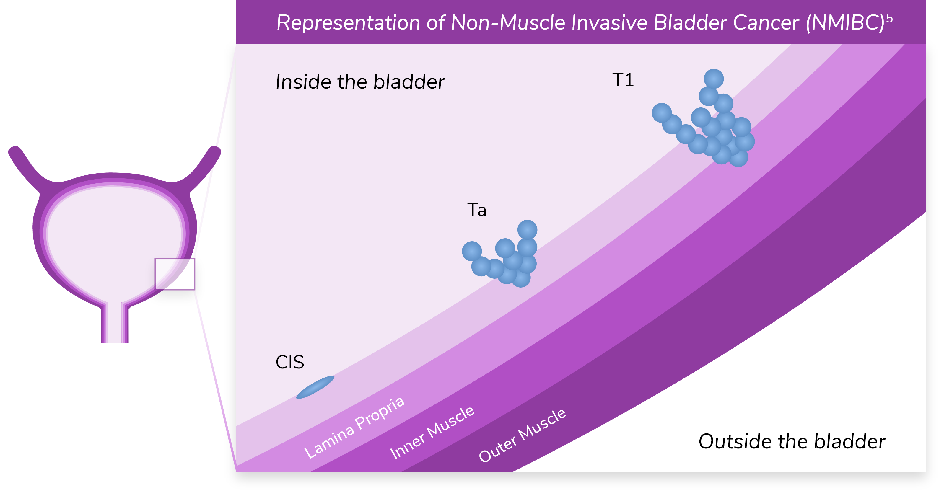 Inset image of a bladder, illustrating the stage at which bladder cancer patients are usually diagnosed